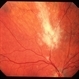 CMV Retinitis in  AIDS